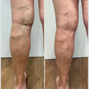 Natural herbal patches for varicose vein relief by VeinKill
