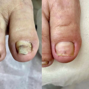 NailBoost Antifungal Spray before and after clear nail results