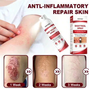 Beef Tallow spray before and after psoriasis skin transformation
