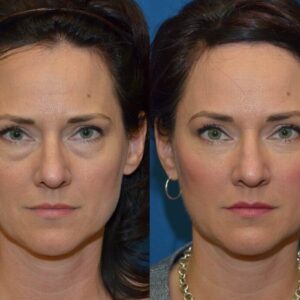 Elycura Eye Bag Stick before and after results on dark circles