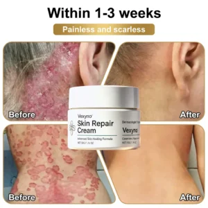Vexyno® Skin Repair Cream for healing damaged skin barriers