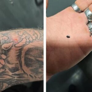 Effective skin tag and fibroid removal liquid by Dermaclear™