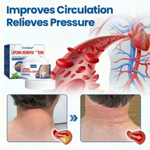 Cvreoz Lipoma Removal Cream before and after results