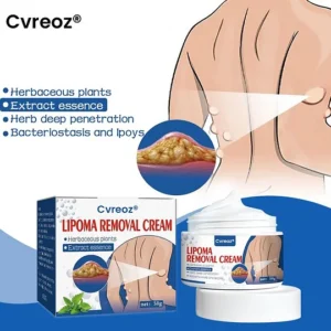 Natural lipoma treatment cream by Cvreoz for skin bumps