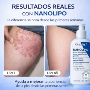 Oveallgo Nanolipo cream for genital fungus and wart removal