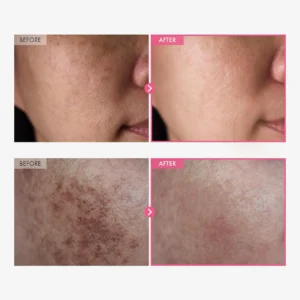 alpha arbutin cream for uneven skin tone correction