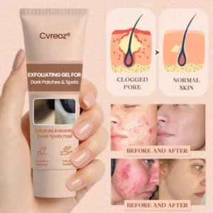 exfoliating gel for dark spots and uneven skin tone