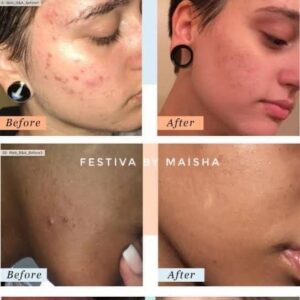 PanOxyl Acne Foaming Wash 10% benzoyl peroxide for severe acne treatment